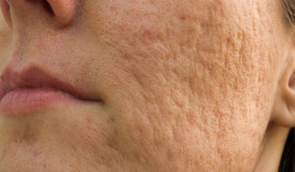 acne scars