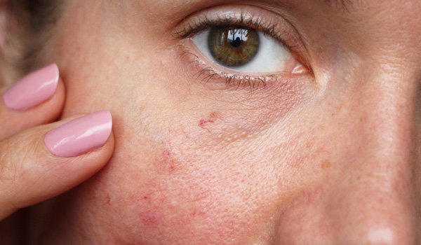 face broken capillaries