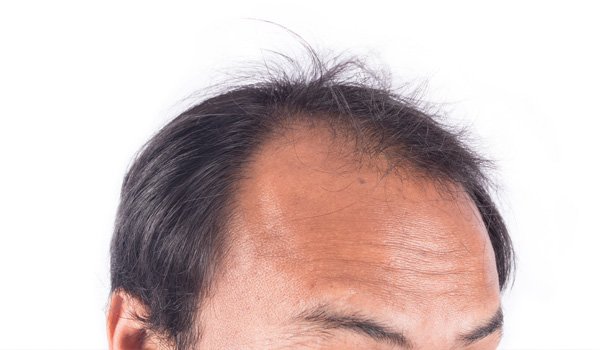 hair loss