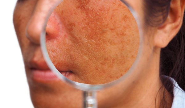 melasma