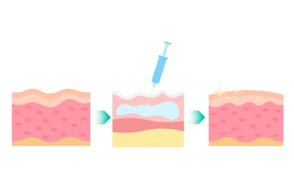 Plinest - Polynucleotides (HPT) for Anti Ageing