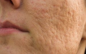 acne scars